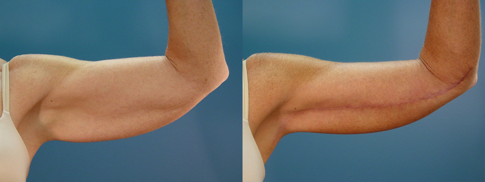 brachioplasty