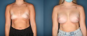 breast-augmentation-patient-front
