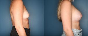 breast-augmentation-patient-side