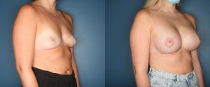 breast-augmentation-patient-third