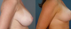 breast-reduc-06b