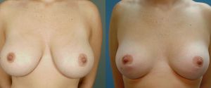 breast-reduc-07a