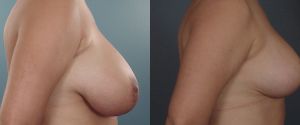 breast-reduc-08b