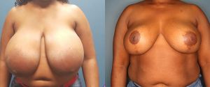 breast-reduc-p12a