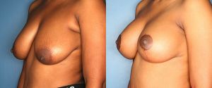 breast-reduction-patient-26-2