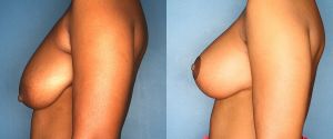 breast-reduction-patient-26-3