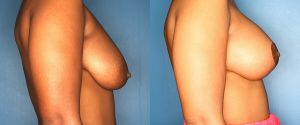 breast-reduction-patient-26-4