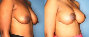 breast-reduction-patient-26-5