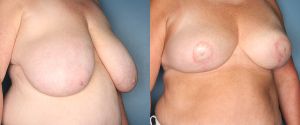 breast-reduction-patient-27-2
