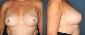 breast-reduction-patient-3