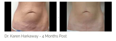 THERMI treatment, before and after 4 months treatment