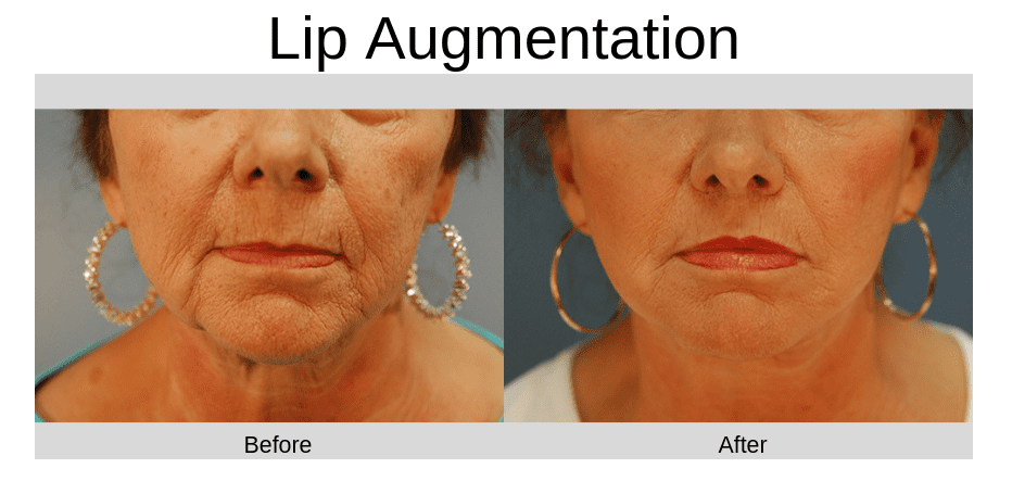 Lip Augmentation Before and After treatment