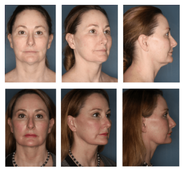 before-and-after-showing-the-results-of-a-facetite-treatment