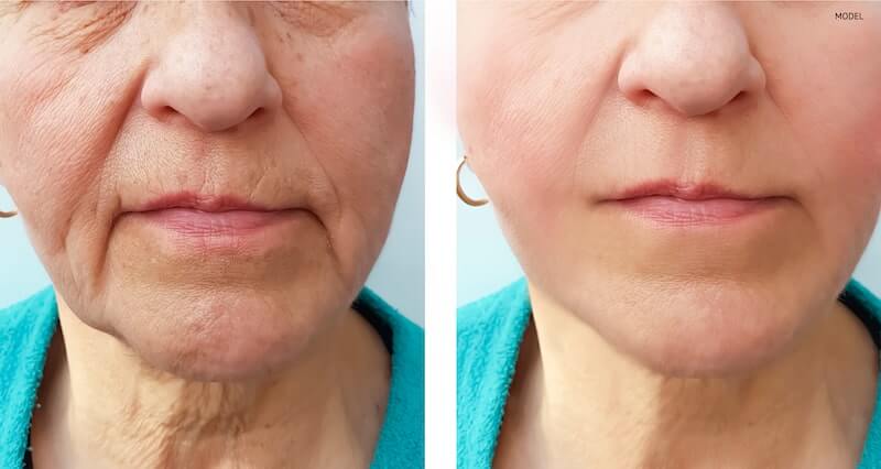 Before and after image of a model demonstrating a facial rejuvenation treatment on the lower face.