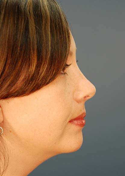 Rhinoplasty Patient After