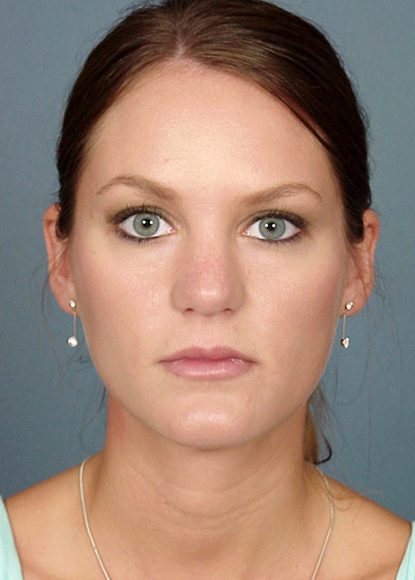 Rhinoplasty Patient Before