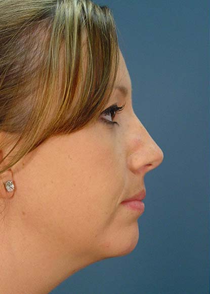 Rhinoplasty Patient Before