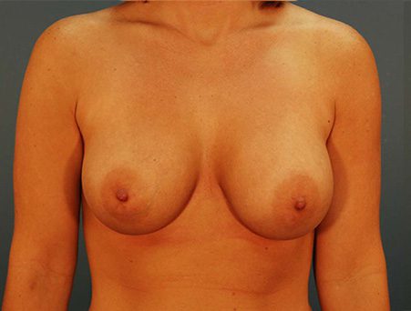 Breast Augmentation Patient After