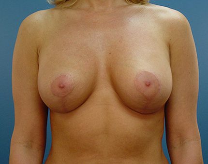 Breast Lift Patient After
