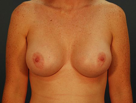 Breast Augmentation Patient After