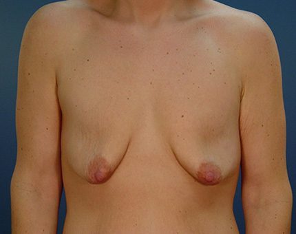 Breast Lift Patient Before