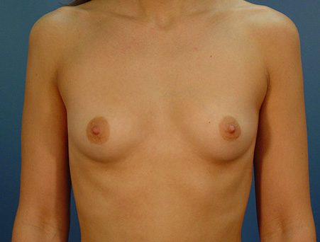 Breast Augmentation Patient Before
