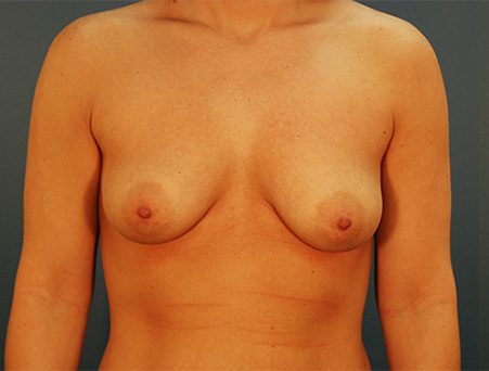 Breast Augmentation Patient Before