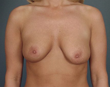 Breast Lift Patient Before