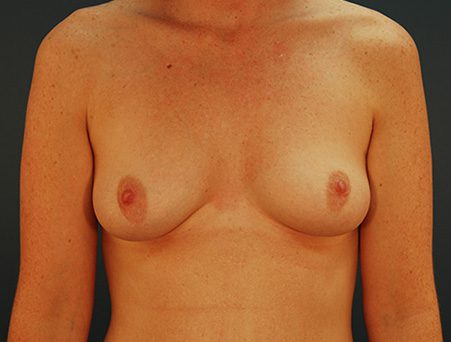 Breast Augmentation Patient Before