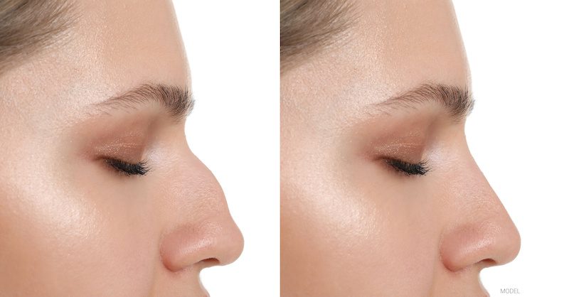 Before and after nose job.