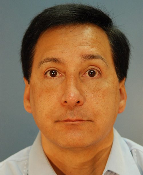 Case--401 | After AFI To Face 