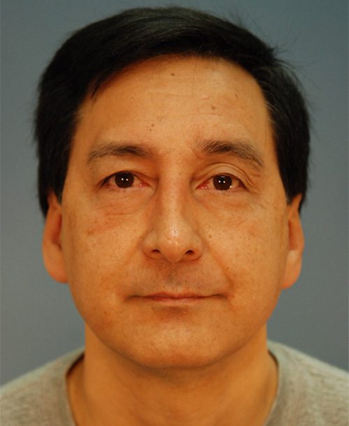 Case--401 | Before AFI To Face 