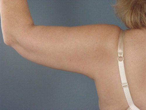 Case--8613 | After Brachioplasty 