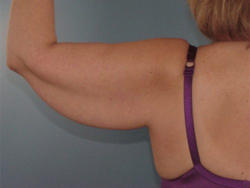 Case--8613 | Before Brachioplasty 