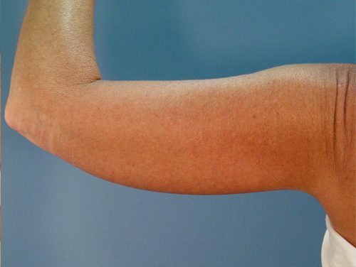 Case--8711 | After Brachioplasty 