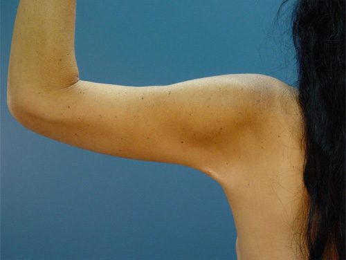 Case--3475 | After Brachioplasty 