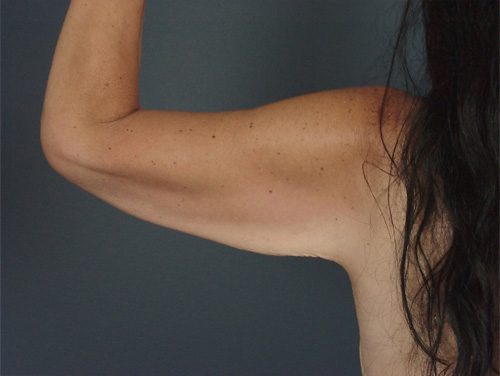 Case--3475 | Before Brachioplasty 