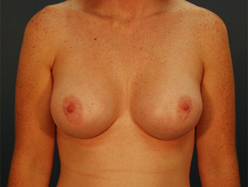 Case--3204 | After Breast 