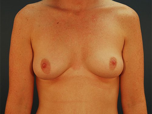Case--3204 | Before Breast 