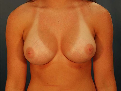 Case--1779 | After Breast 