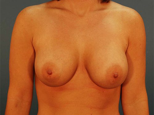 Case--2431 | After Breast 