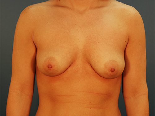 Case--2431 | Before Breast 