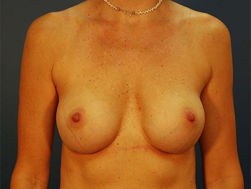 Case--6799 | After Breast 