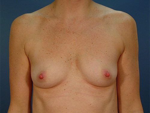 Case--6799 | Before Breast 