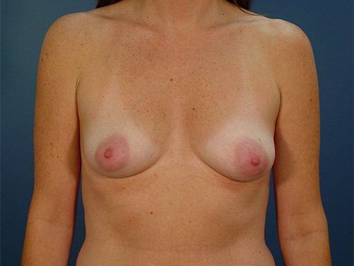 Case--6256 | Before Breast 