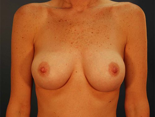 Case--5150 | After Breast 