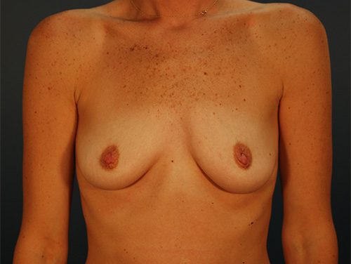 Case--5150 | Before Breast 