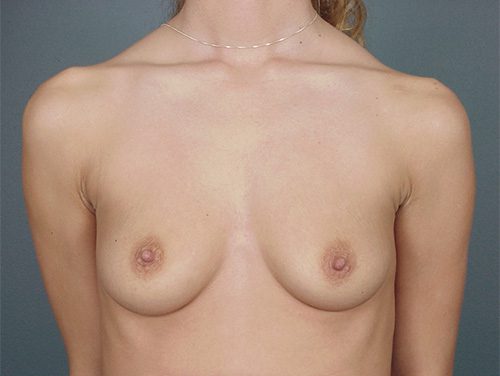 Case--6746 | Before Breast 