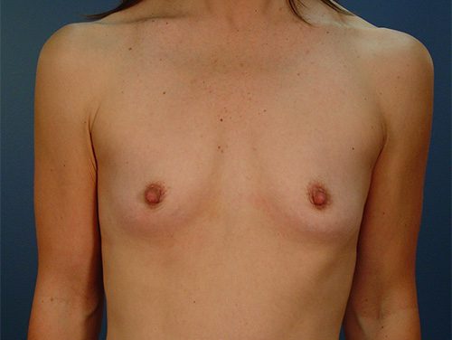 Case--1618 | Before Breast 