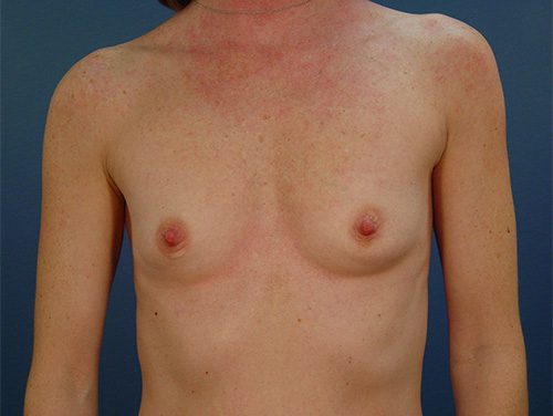 Case--8311 | Before Breast 